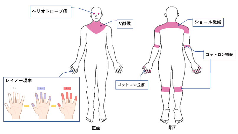 皮膚 筋炎 で 誤っ て いる の は どれ か