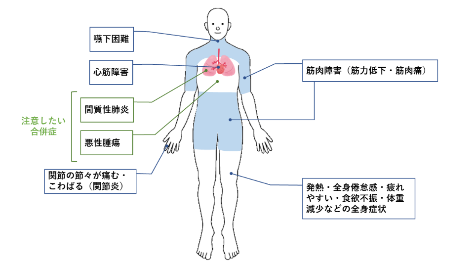 皮膚 筋炎 で 誤っ て いる の は どれ か