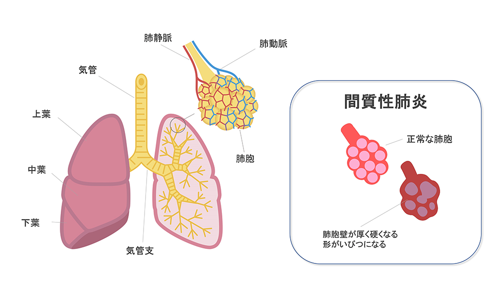 間 質 性 肺炎 家族 に できること