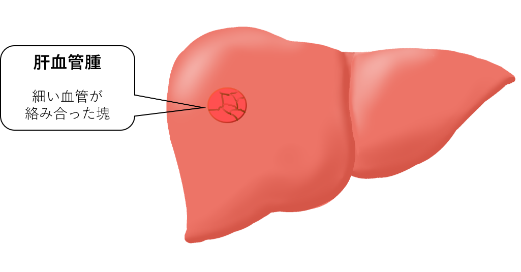 肝 血管 腫 癌 だっ た